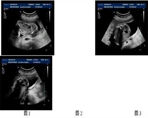 代孕怎样移植胚胎_怀孕92天能看出男女吗
